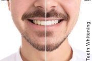 How to Whiten Teeth Without Damaging Enamel?
